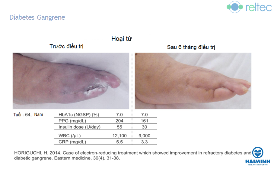 Điều trị lâm sàng hoại tử chân ở bệnh nhân tiểu đường